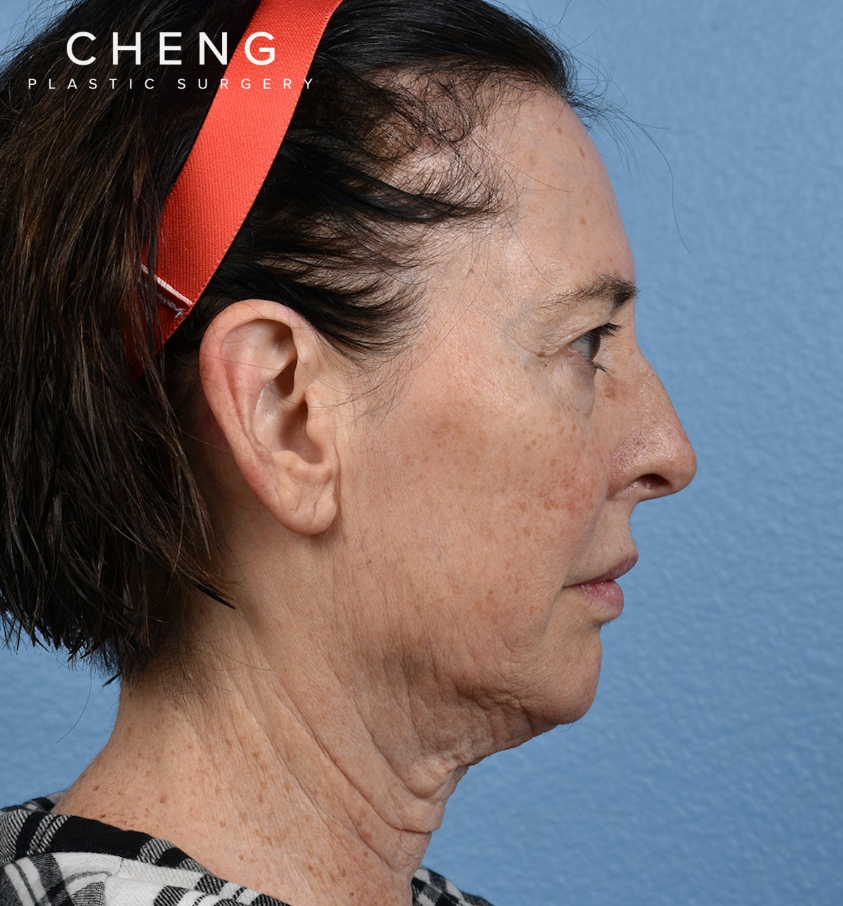 Hidden Patients Before & After Gallery - Patient 345137 - Image 5