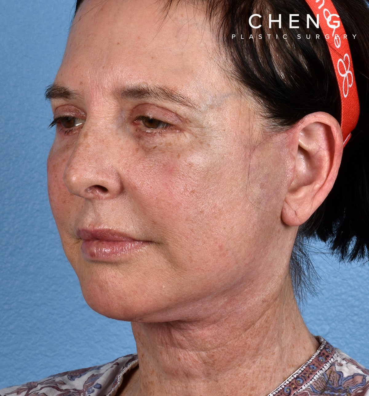 Hidden Patients Before & After Gallery - Patient 345137 - Image 8