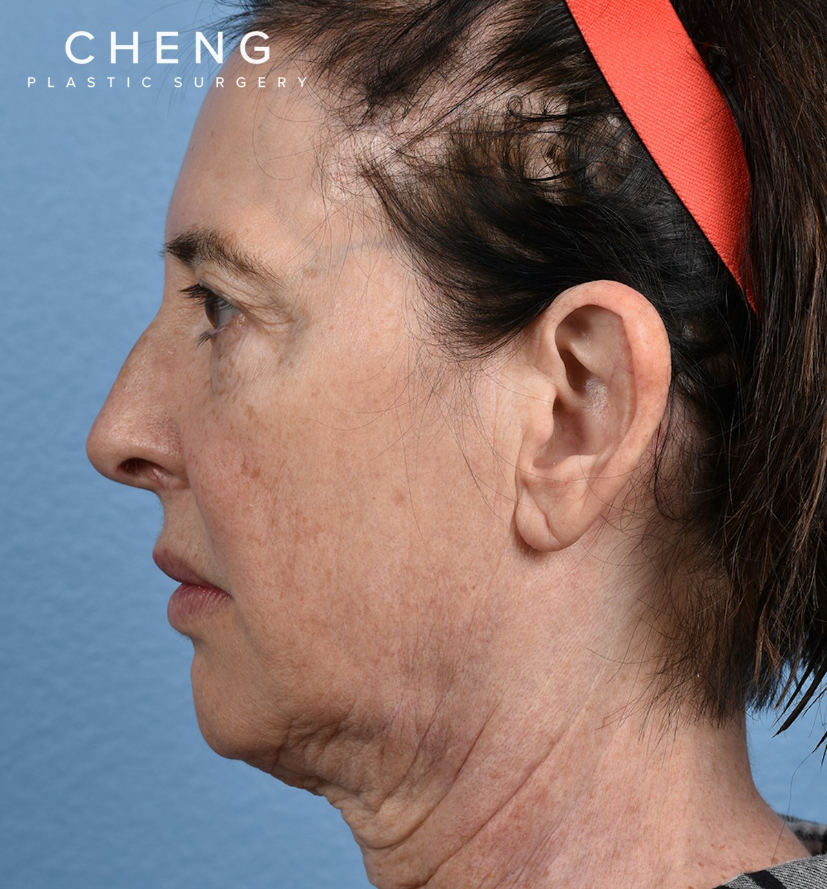Hidden Patients Before & After Gallery - Patient 345137 - Image 9