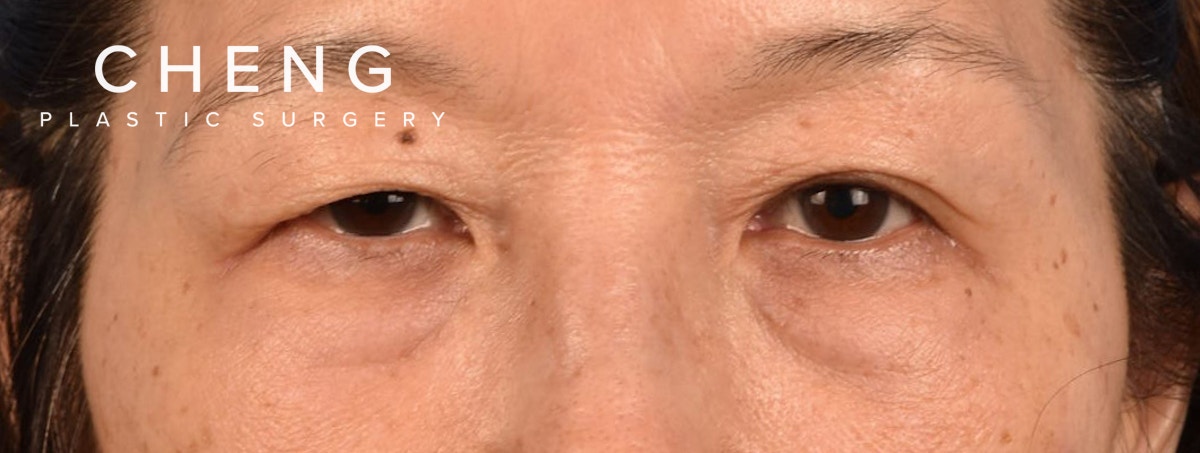Blepharoplasty Before & After Gallery - Patient 268032 - Image 1