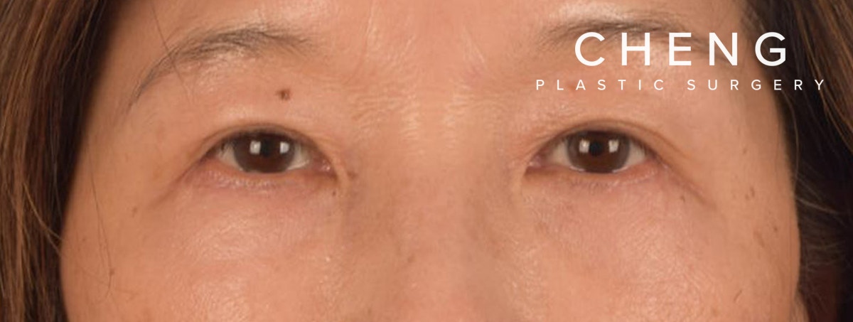 Blepharoplasty Before & After Gallery - Patient 268032 - Image 2