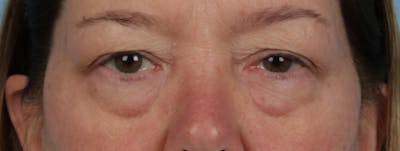 Hidden Patients Before & After Gallery - Patient 220069 - Image 1