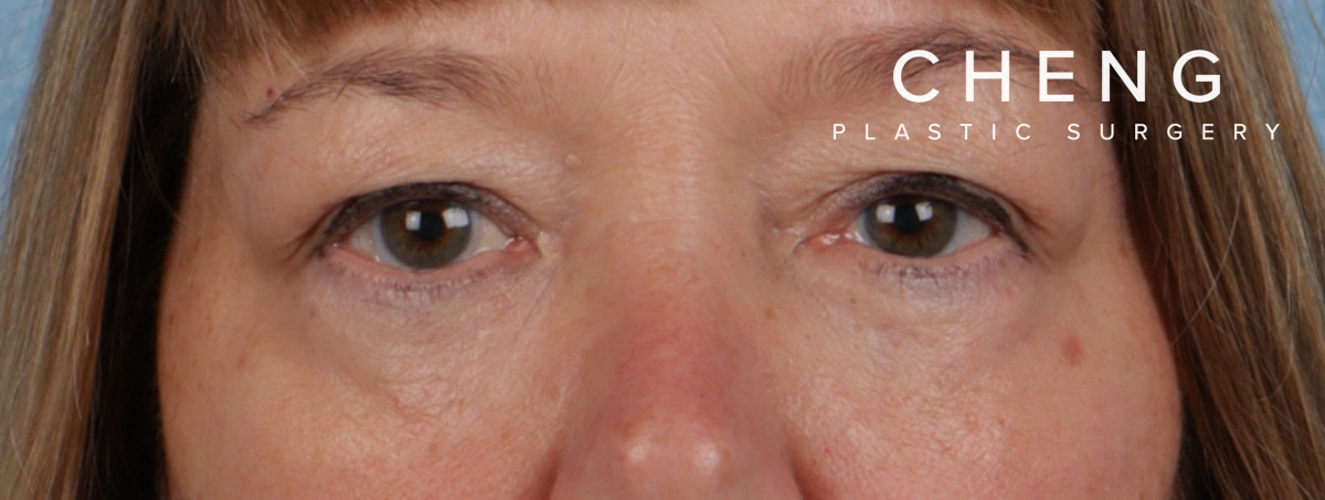 Hidden Patients Before & After Gallery - Patient 385354 - Image 2