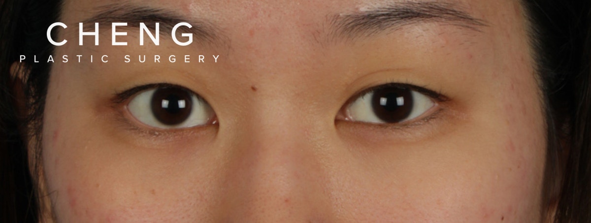 Blepharoplasty Before & After Gallery - Patient 407537 - Image 1