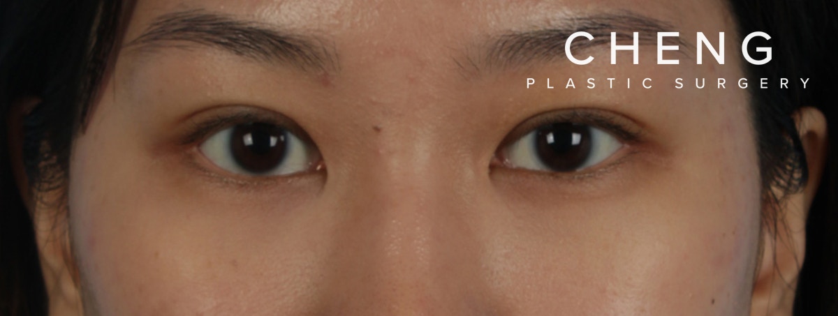 Blepharoplasty Before & After Gallery - Patient 407537 - Image 2