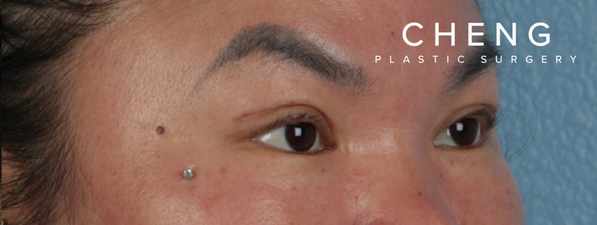 Hidden Patients Before & After Gallery - Patient 873403 - Image 4