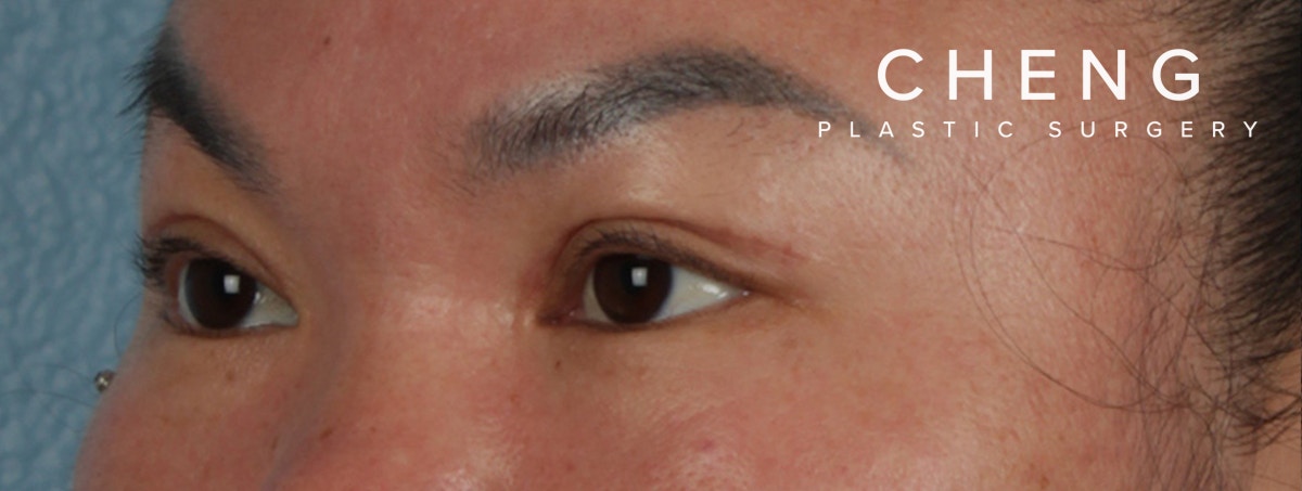 Hidden Patients Before & After Gallery - Patient 873403 - Image 6