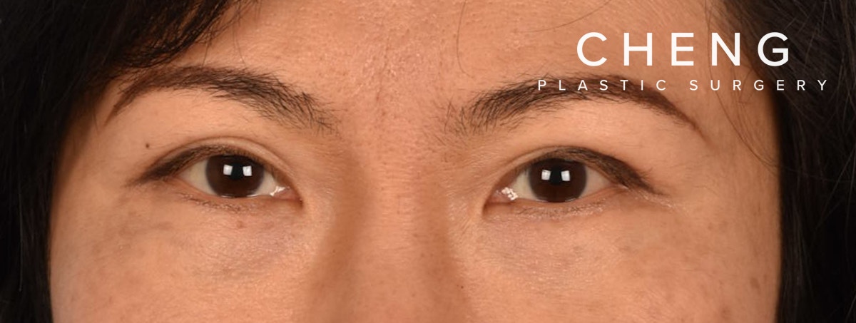 Blepharoplasty Before & After Gallery - Patient 212914 - Image 2