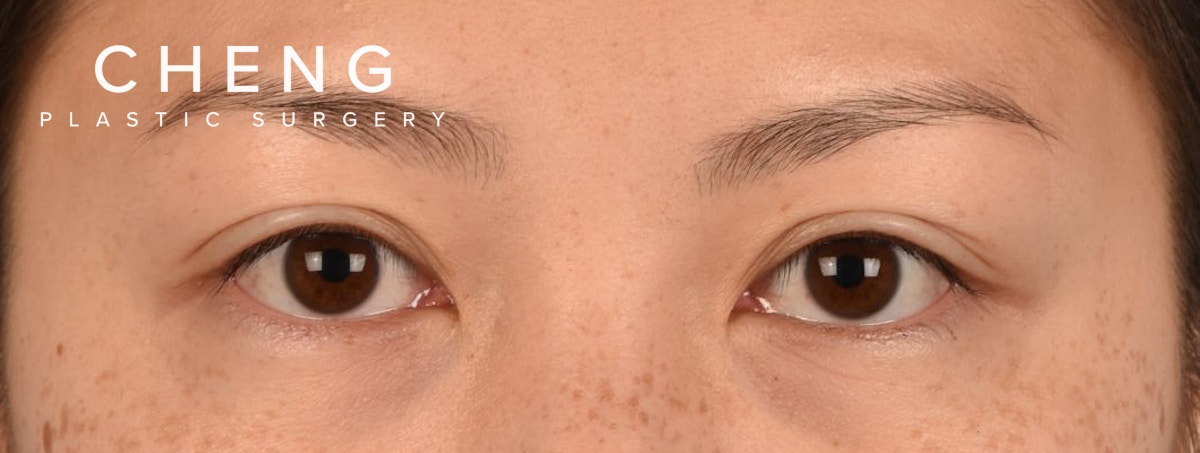 Hidden Patients Before & After Gallery - Patient 136681 - Image 1