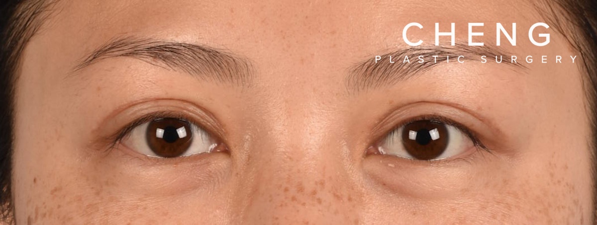 Hidden Patients Before & After Gallery - Patient 136681 - Image 2