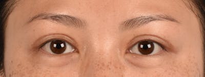 Hidden Patients Before & After Gallery - Patient 136681 - Image 2