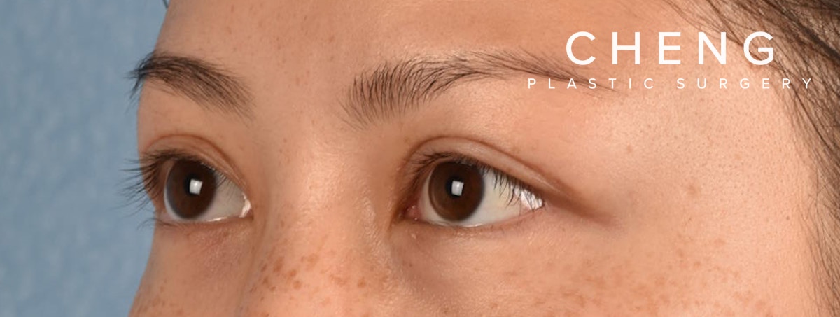 Hidden Patients Before & After Gallery - Patient 136681 - Image 4
