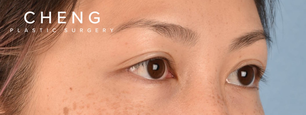 Hidden Patients Before & After Gallery - Patient 136681 - Image 5