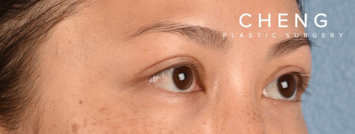 Hidden Patients Before & After Gallery - Patient 136681 - Image 6