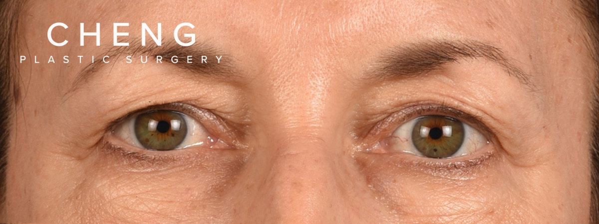 Blepharoplasty Before & After Gallery - Patient 721539 - Image 1