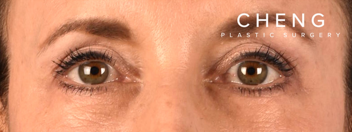Blepharoplasty Before & After Gallery - Patient 721539 - Image 2