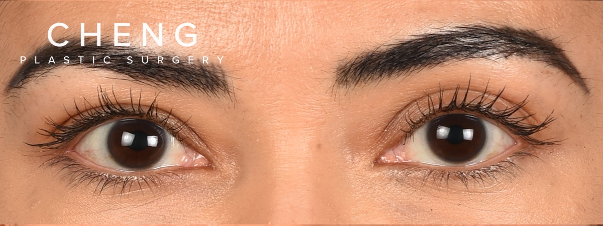 Blepharoplasty Before & After Gallery - Patient 181625 - Image 1