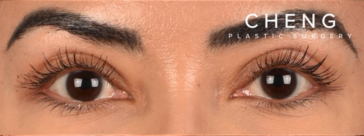 Blepharoplasty Before & After Gallery - Patient 181625 - Image 2