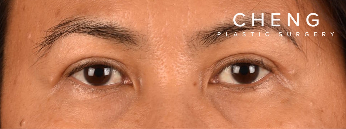 Blepharoplasty Before & After Gallery - Patient 374478 - Image 2