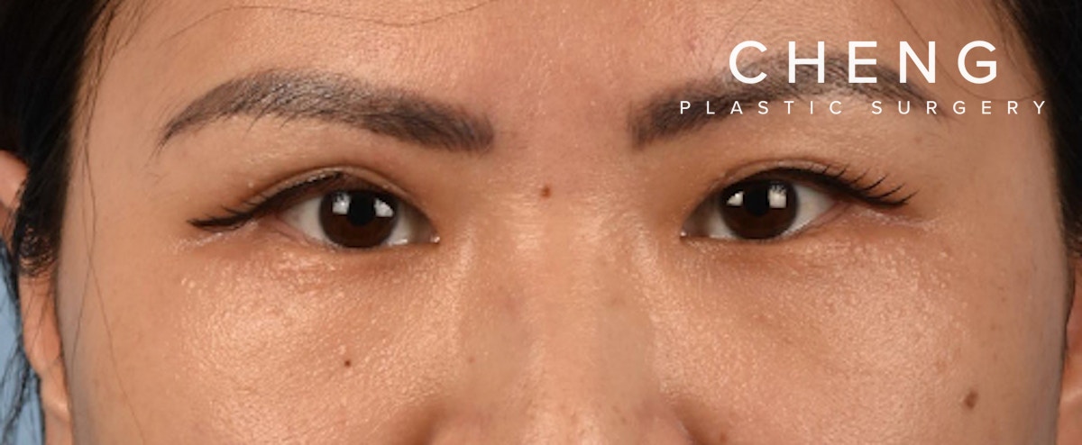 Hidden Patients Before & After Gallery - Patient 181350 - Image 2