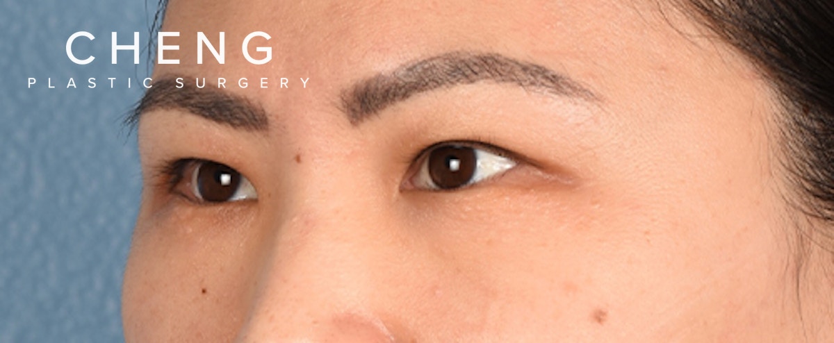 Hidden Patients Before & After Gallery - Patient 181350 - Image 3