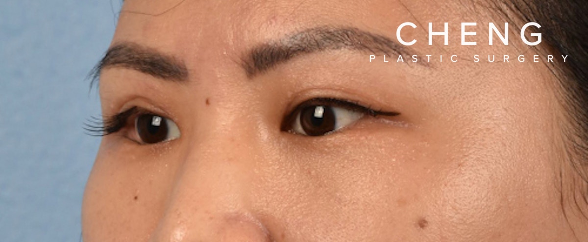Hidden Patients Before & After Gallery - Patient 181350 - Image 4