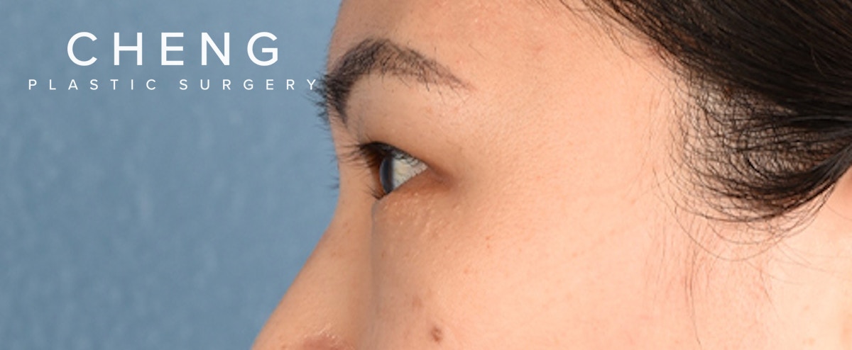 Hidden Patients Before & After Gallery - Patient 181350 - Image 5
