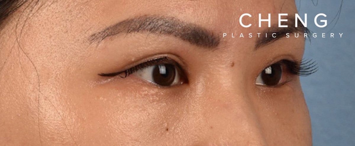 Hidden Patients Before & After Gallery - Patient 181350 - Image 8