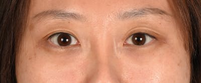 Hidden Patients Before & After Gallery - Patient 300838 - Image 1