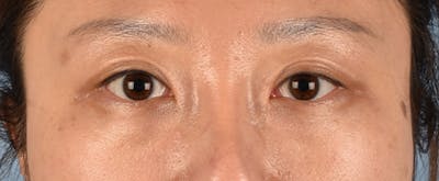Hidden Patients Before & After Gallery - Patient 300838 - Image 2