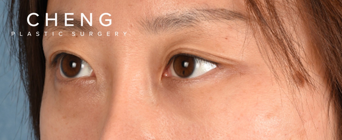 Hidden Patients Before & After Gallery - Patient 300838 - Image 5