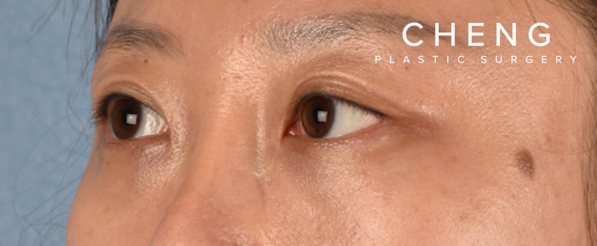 Hidden Patients Before & After Gallery - Patient 300838 - Image 6