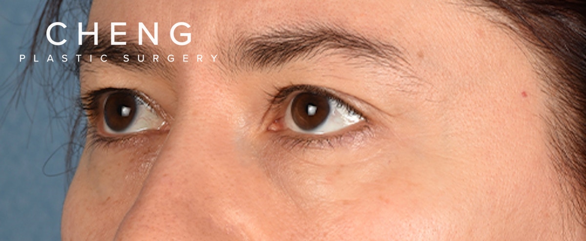 Hidden Patients Before & After Gallery - Patient 239841 - Image 3