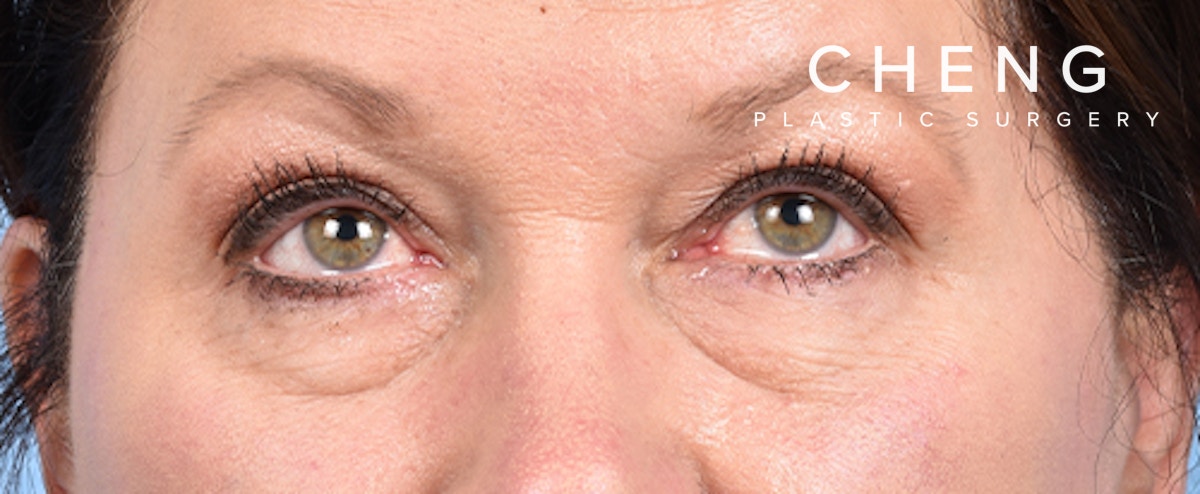 Hidden Patients Before & After Gallery - Patient 140219 - Image 2