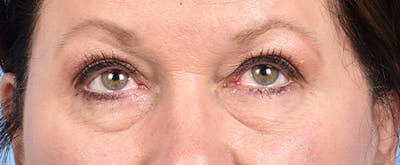 Hidden Patients Before & After Gallery - Patient 140219 - Image 2