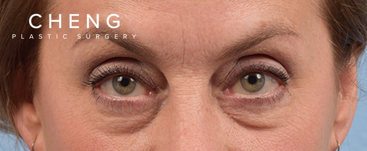 Hidden Patients Before & After Gallery - Patient 561726 - Image 1
