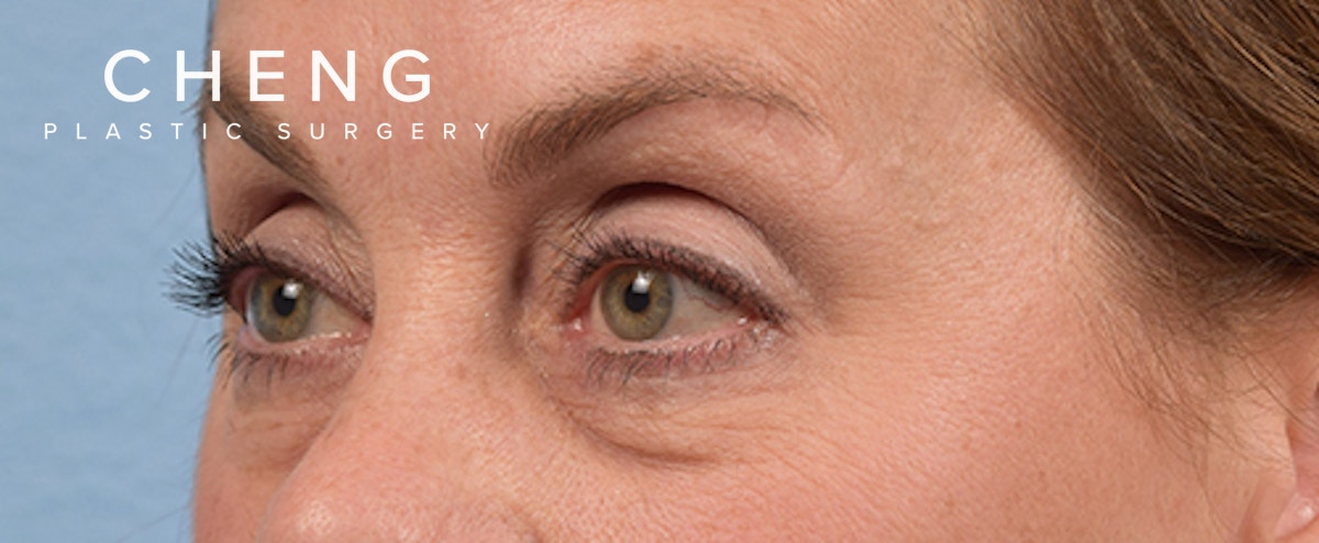 Hidden Patients Before & After Gallery - Patient 561726 - Image 5