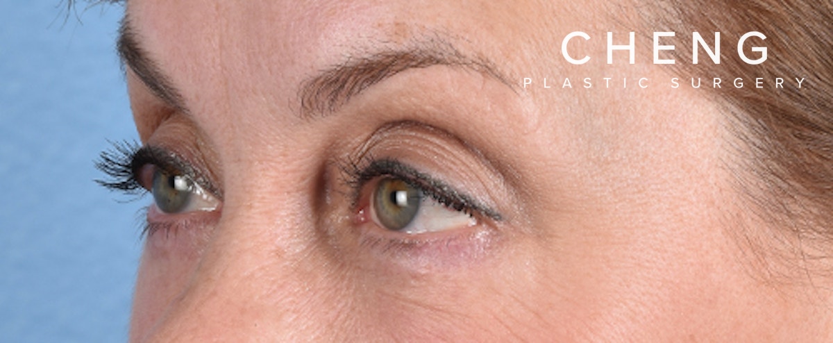 Hidden Patients Before & After Gallery - Patient 561726 - Image 6