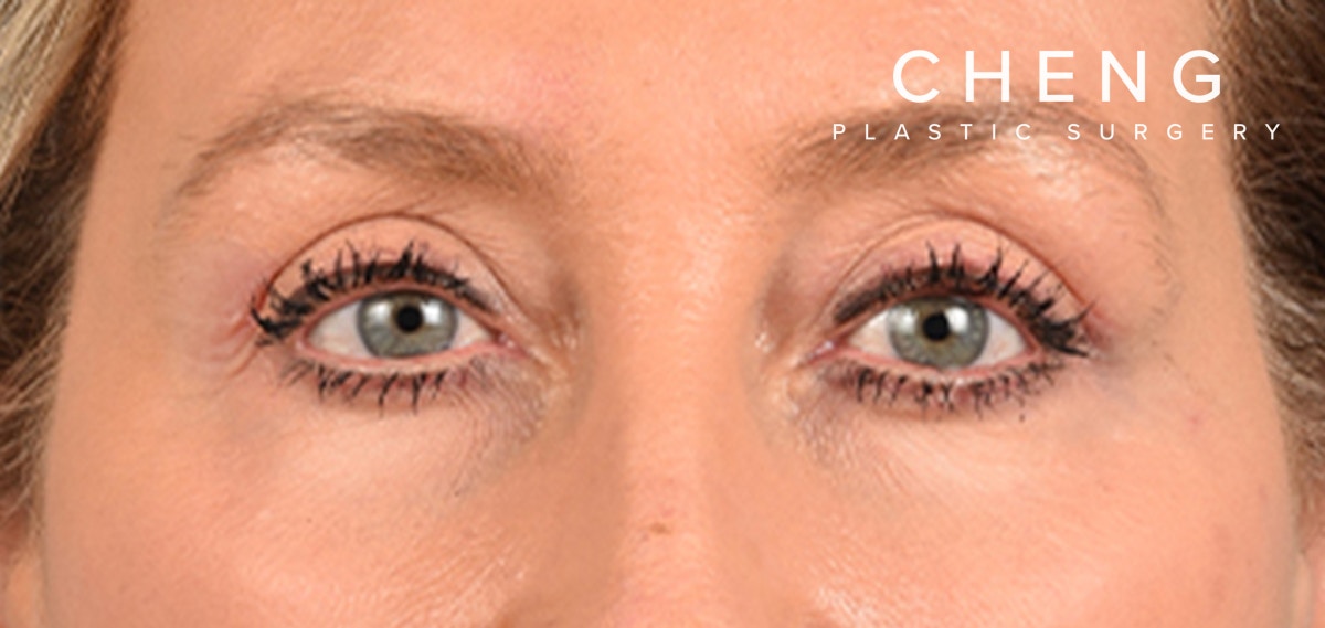 Hidden Patients Before & After Gallery - Patient 379996 - Image 2