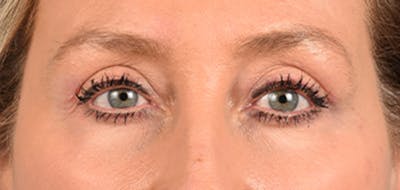 Hidden Patients Before & After Gallery - Patient 379996 - Image 2