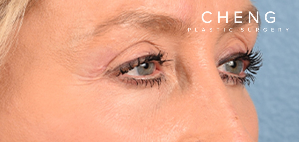 Hidden Patients Before & After Gallery - Patient 379996 - Image 4