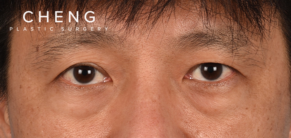 Blepharoplasty Before & After Gallery - Patient 394322 - Image 1