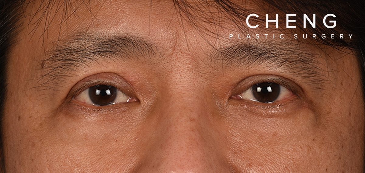 Blepharoplasty Before & After Gallery - Patient 394322 - Image 2