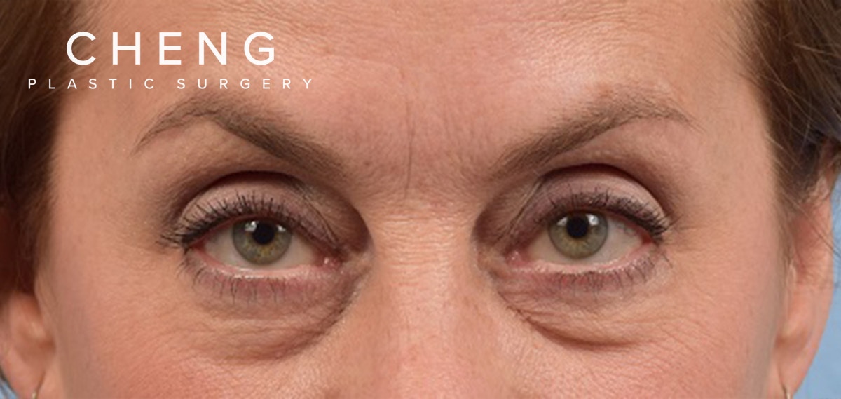 Hidden Patients Before & After Gallery - Patient 132269 - Image 1