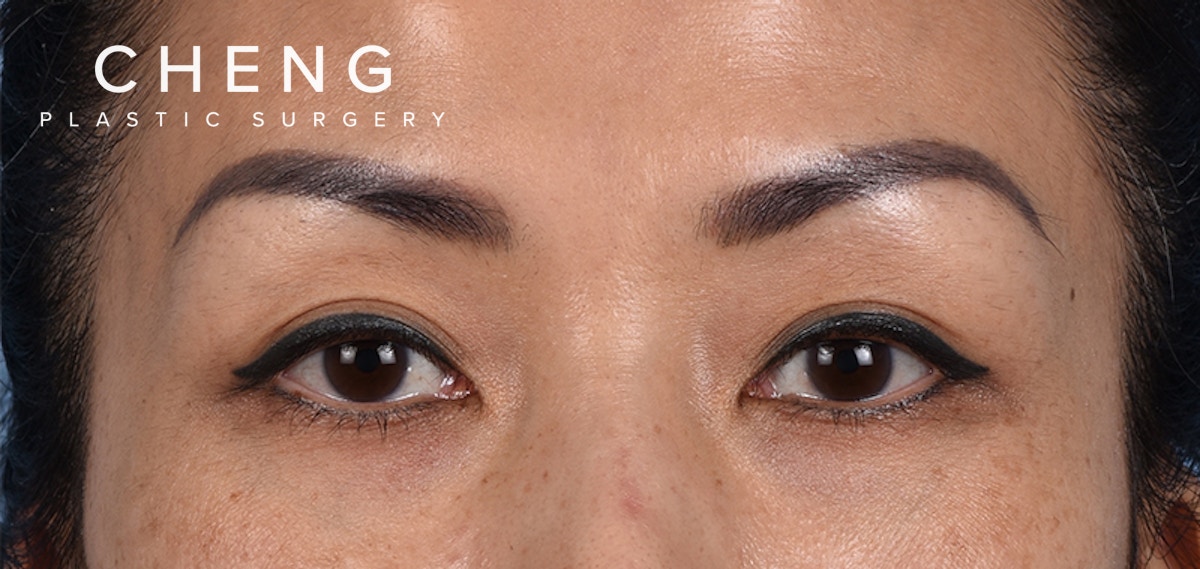 Hidden Patients Before & After Gallery - Patient 109685 - Image 1