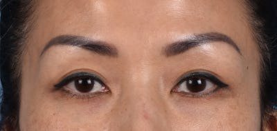 Hidden Patients Before & After Gallery - Patient 109685 - Image 1