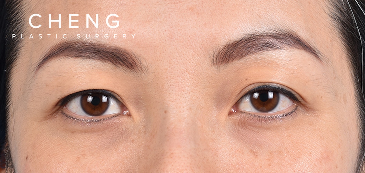 Blepharoplasty Before & After Gallery - Patient 651932 - Image 1