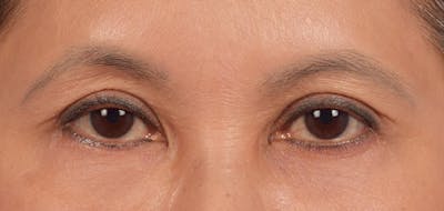 Hidden Patients Before & After Gallery - Patient 610926 - Image 2