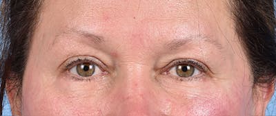 Hidden Patients Before & After Gallery - Patient 821760 - Image 2