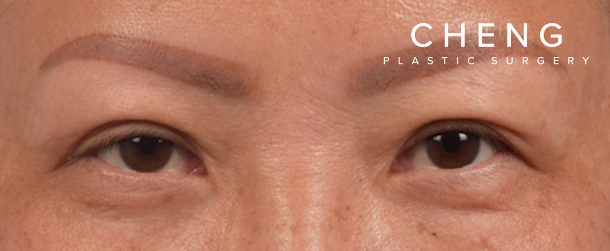 Hidden Patients Before & After Gallery - Patient 127674 - Image 2
